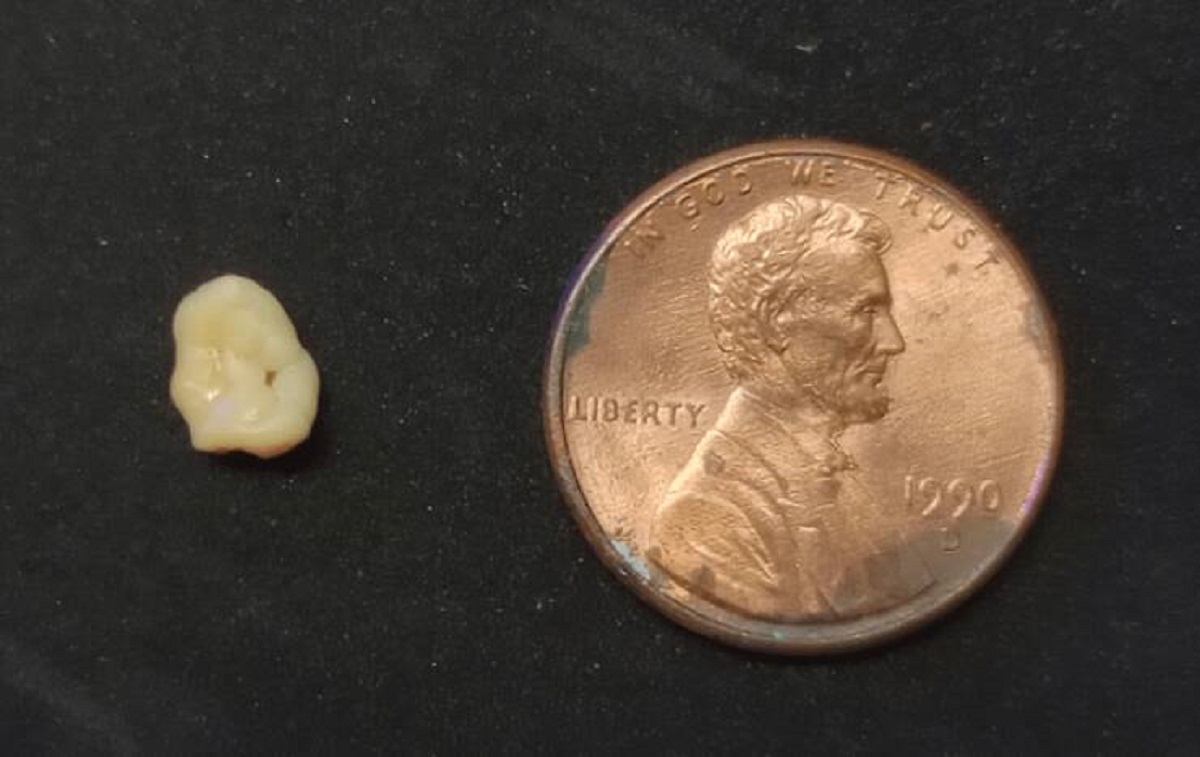 "Woke up to find this boulder of a tonsil stone just lolling around on my tongue."