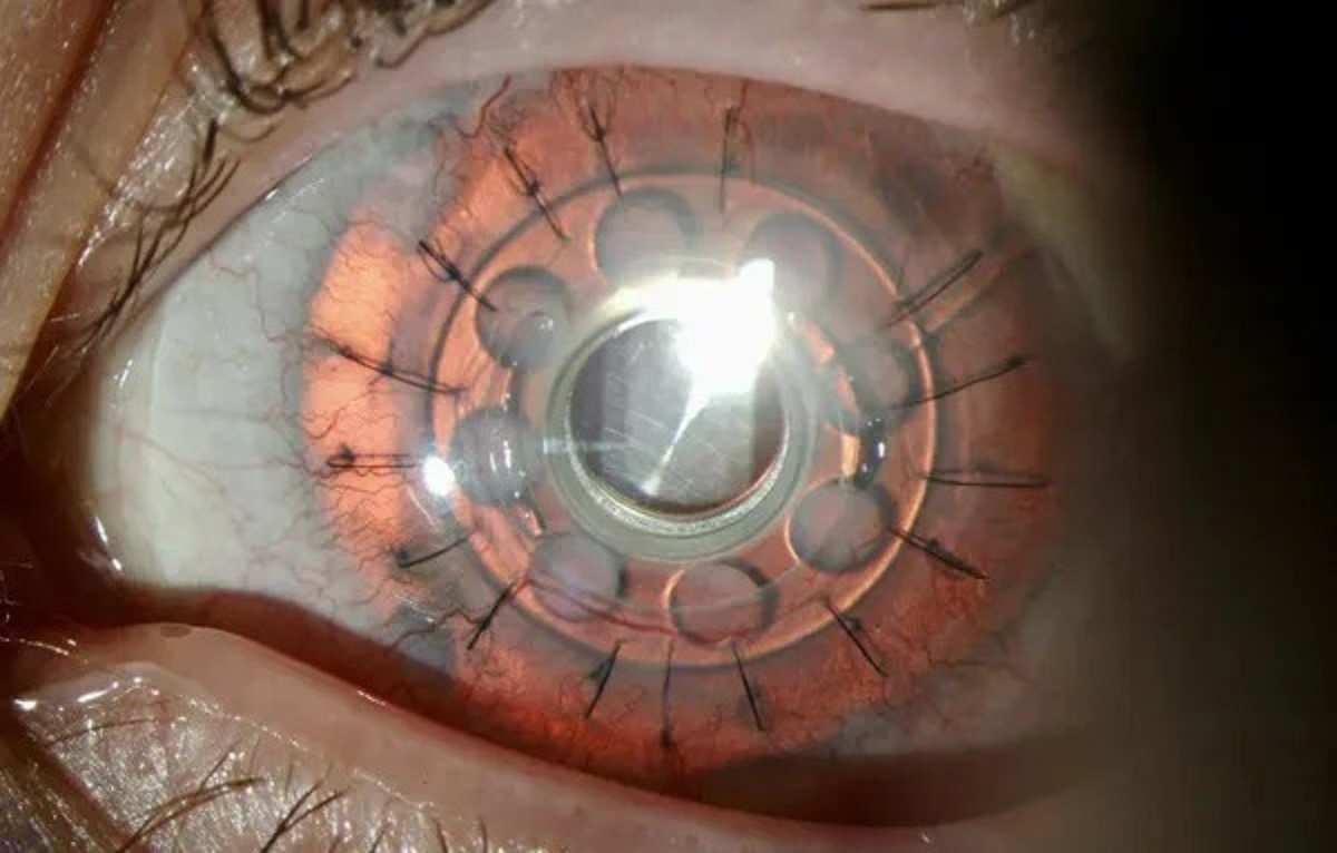 artificial cornea implant.