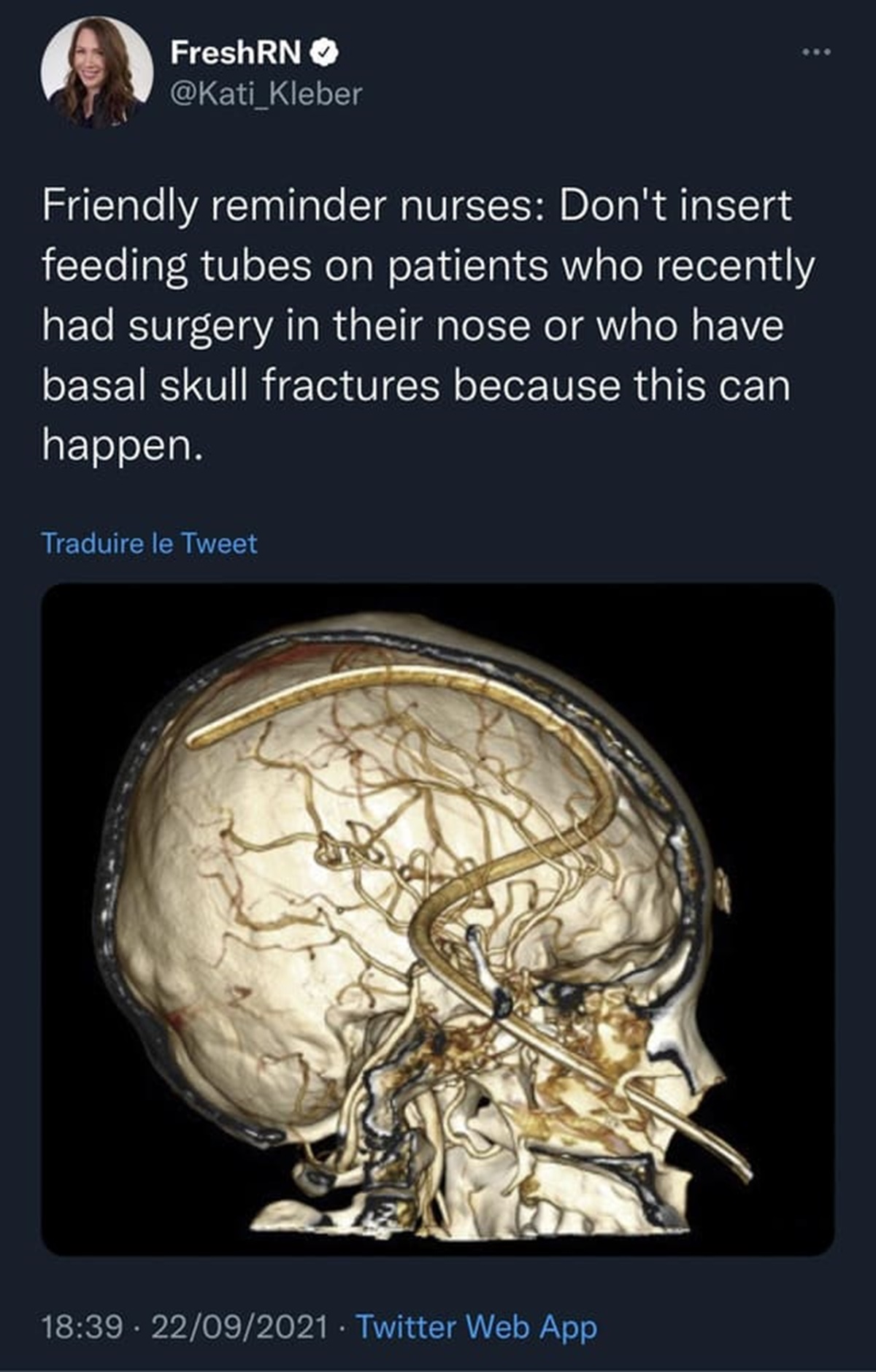 medical imaging - FreshRN Friendly reminder nurses Don't insert feeding tubes on patients who recently had surgery in their nose or who have basal skull fractures because this can happen. Traduire le Tweet 22092021 Twitter Web App