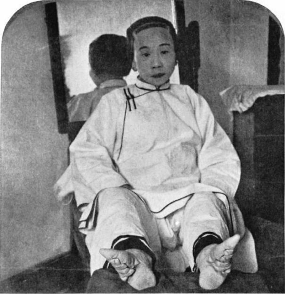 A Chinese Woman Whose Feet Were Bound From Childhood, Late 1800s