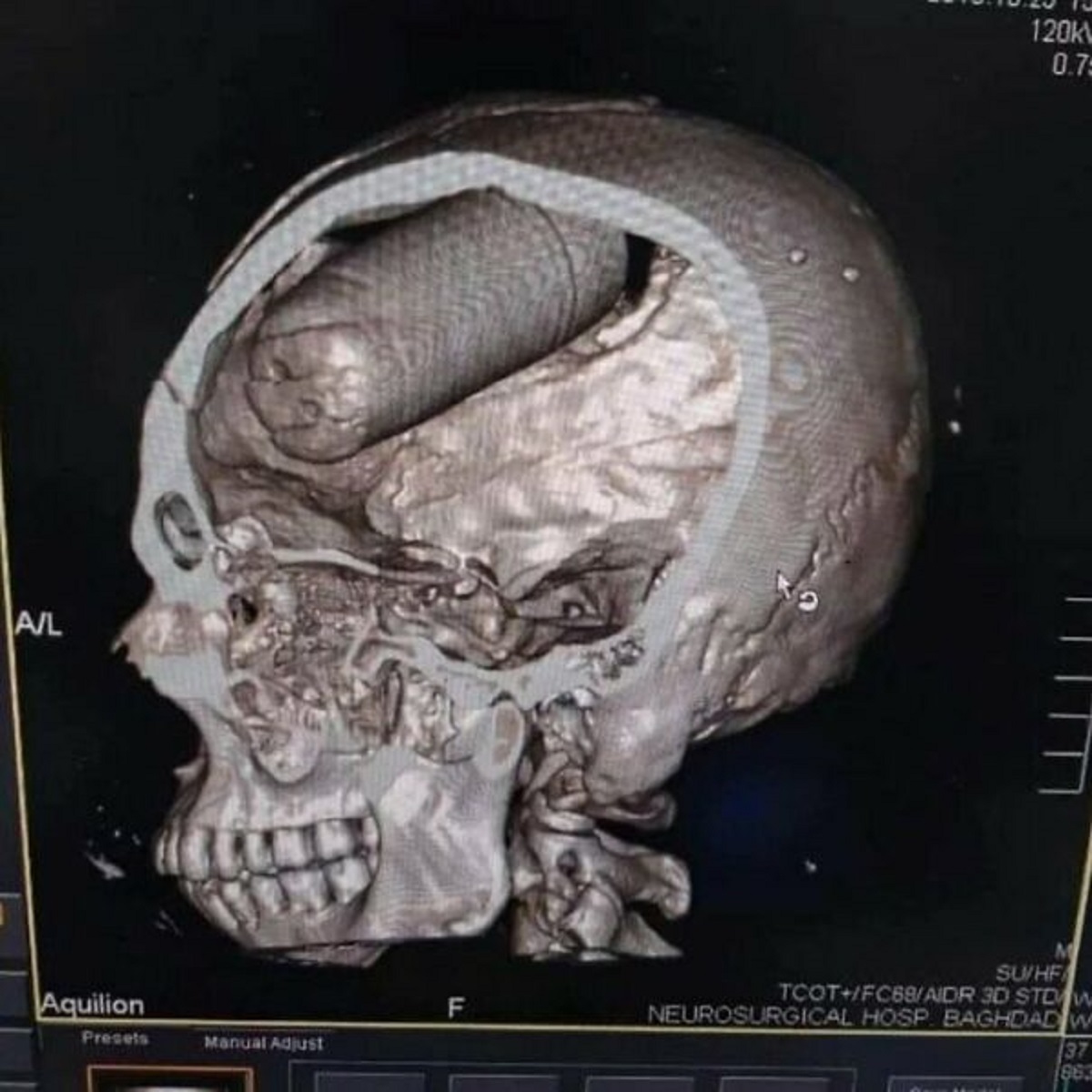 baghdad tear gas canister in head - AL Aquilion F Presets Manual Adjust 0.75 M SuHf TcotFC68Aidr 3D Stdw Neurosurgical Hosp Baghdad W 37 863