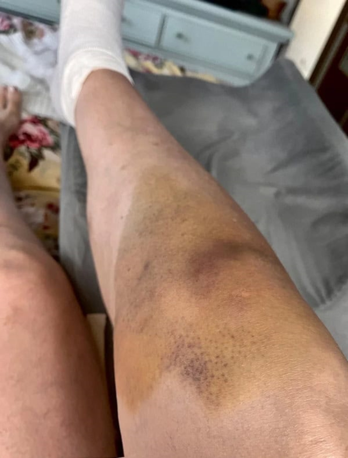 “The bruise on my knee traveled ‘up’ because I’ve had to elevate my leg”