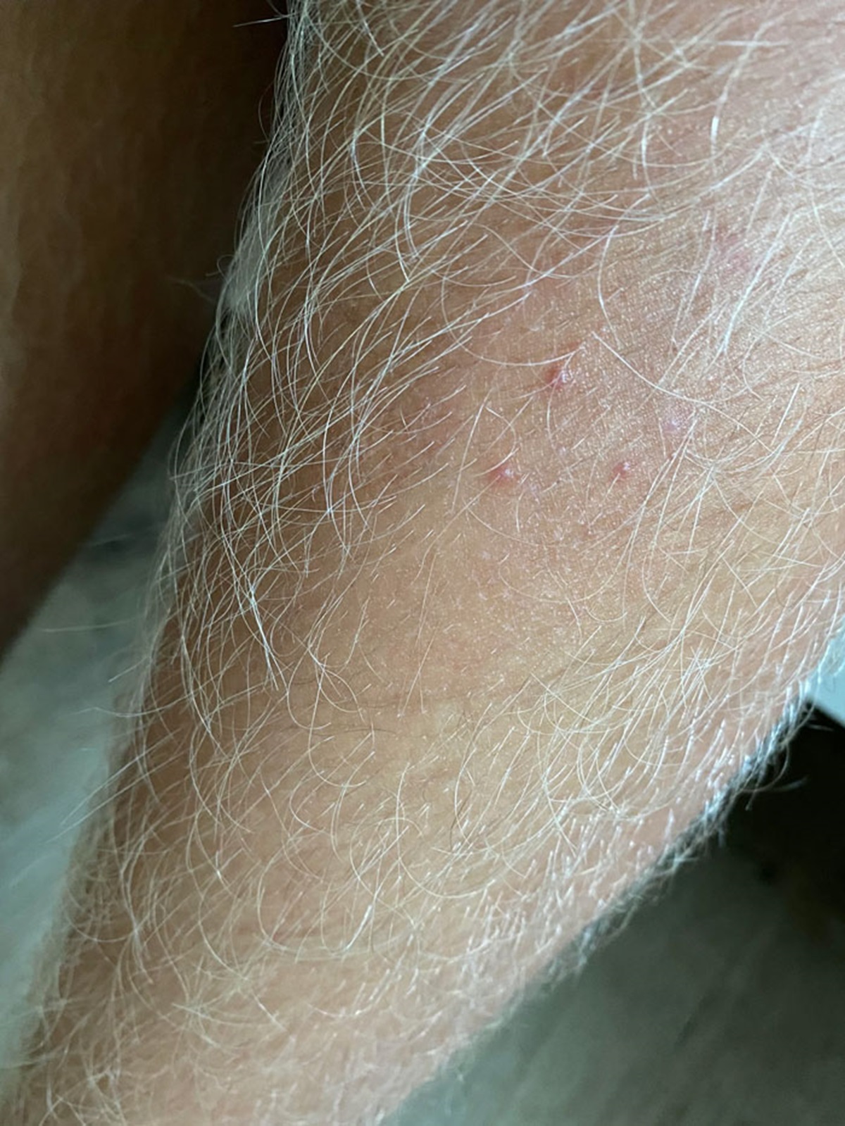 Went Camping With My Friends. While I Slept, One Pulled Out A Patch Of Hair From My Leg