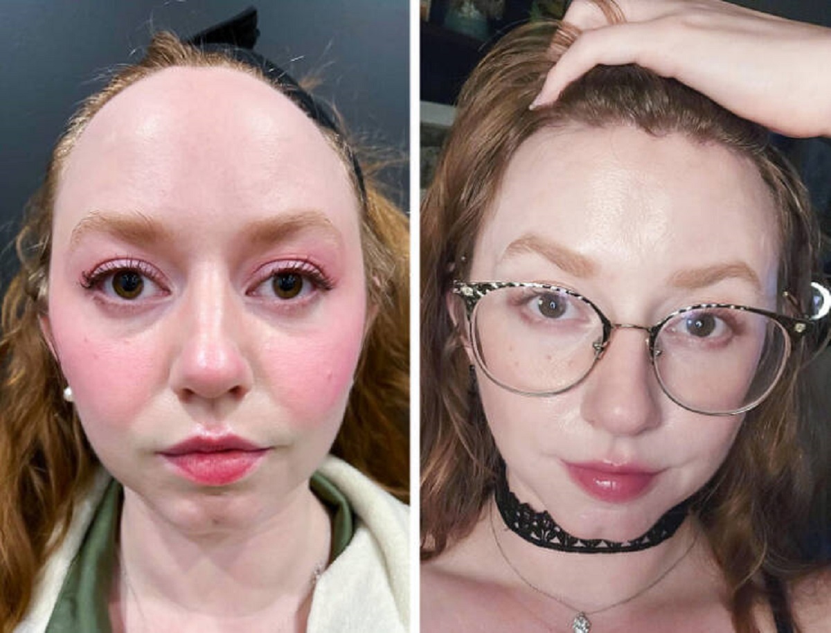 “I had forehead reduction surgery. I feel much more confident now!”