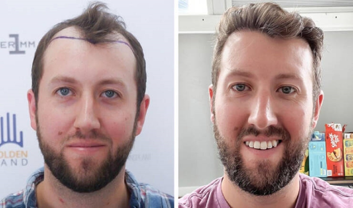 “This is about 1.5 years post op after my hair transplant.”