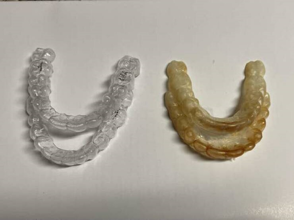 A brand new retainer vs. a very old, very yellow retainer: