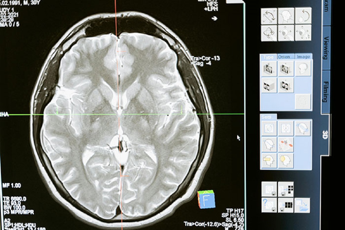 The Canadian government actually tried to fry peoples brains with ECT in order to fix their depression, thinking that the wiping of neurons that have a negative emotional event will fix their depression. Instead, people ended up losing their memory, suffered inconsistent, and forgot their name, all while still having depression.  

This was in part funded by the CIA in an effort to understand memory alteration. .