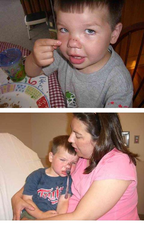Never run with a fork in your hand, as this little boy found out, it will go up your nose.