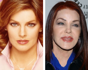 Celebrity Cosmetic Surgery Gone Bad