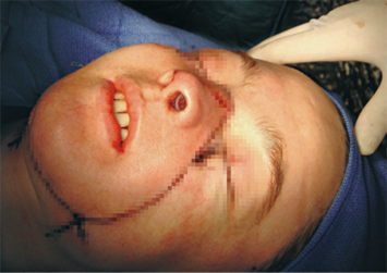 face transplant
