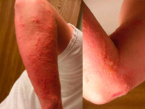 poison ivy rashes and blisters