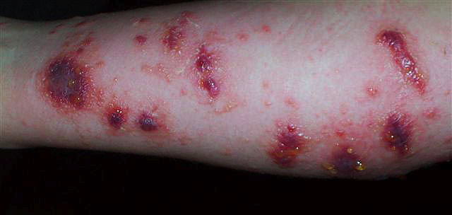 poison ivy rashes and blisters