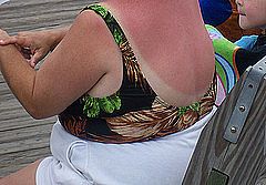 bad sunburns