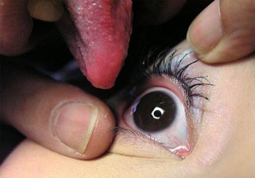 OCULOLINCTUS: Erotic Pleasure Stemming From The Licking Of Someone's Eyeball.