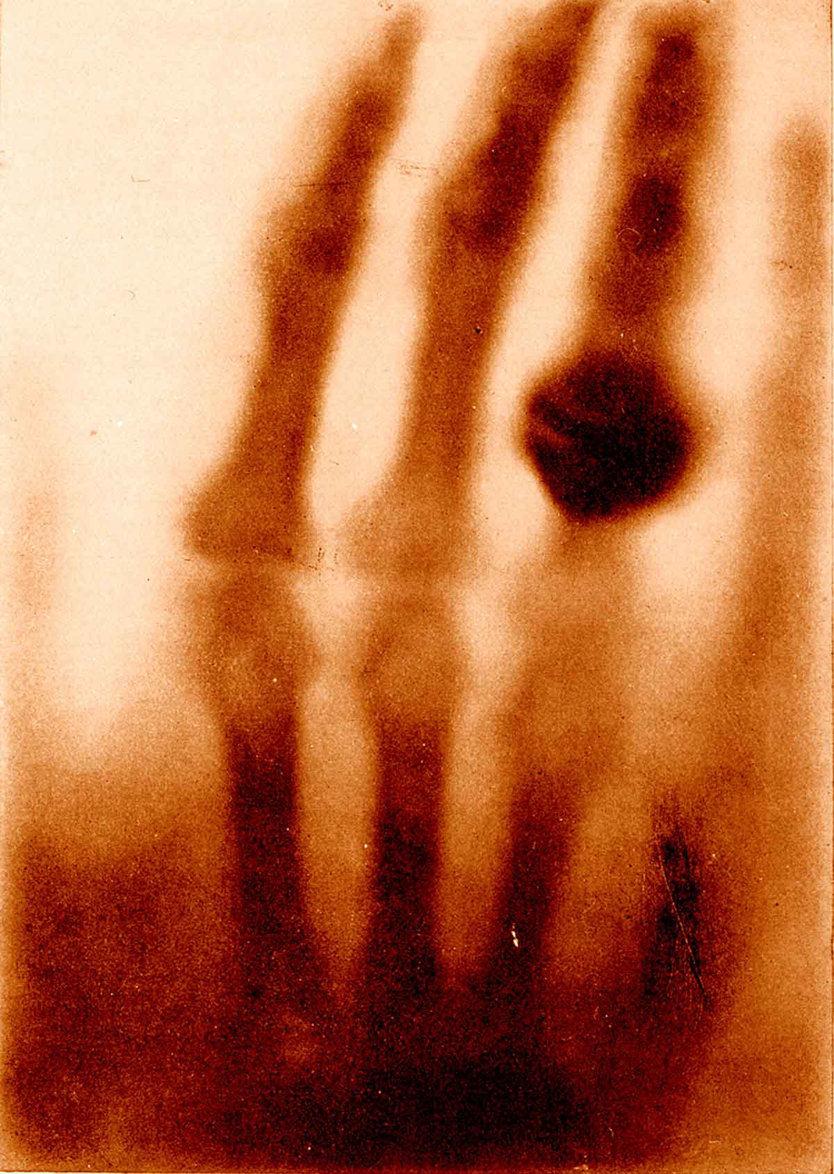 first x-ray