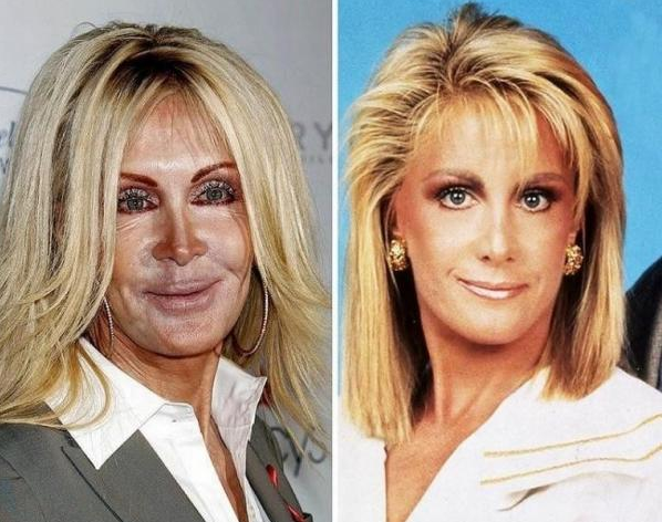 Victims Of Plastic Surgery