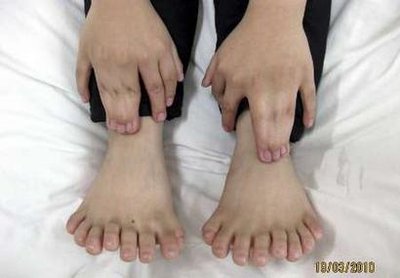 A 6-year-old boy displays his hands and feet at a hospital in Shenyang, Liaoning province, March 19, 2010. The boy, who has 15 fingers and 16 toes gene mutation 
 