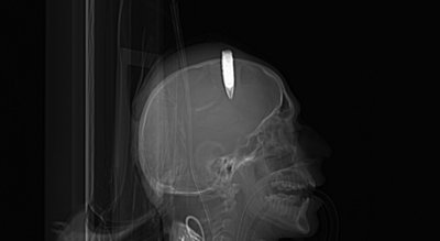CAT Scan shows the placement of a 14.5 millimeter high explosive incendiary round which was removed from the scalp of an Afghan National Army solder at the Craig Joint Theater Hospital, Bagram Airfield, Afghanistan