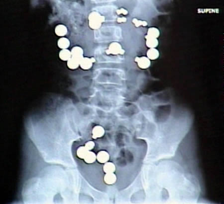 8-year-old Haley Lents of Indiana swallowed 10 magnets and 20 steel balls from a Magnetix toy set. The magnets and balls attracted one another within her digestive tract, ripping a total of eight holes in her intestines and forcing her parents to rush her to the hospital for emergency surgery. Lents later told reporters that the magnets and steel balls "looked like candy."