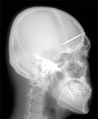 The 5-centimeter nail shown in this X-ray was found after a man came to a Seoul, South Korea, hospital complaining of a severe headache. After examining and interviewing the man, doctors speculated that the nail had been the result of an accident four years before his visit, but that the man did not know the nail was lodged in his head. 