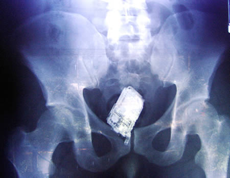 This X-ray reveals a cell phone lodged in a Salvadoran prisoner's lower intestine. The man is one of four prisoners who are members of the Mara Salvatrucha street gang. The men were caught with cell phones, spare chips and a charger that they had attempted to smuggle, according to authorities at San Salvador's Zacatecoluca prison. 