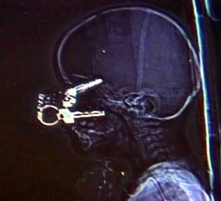 This X-ray shows how, during a fall, a car key penetrated the eyelid of 17-month-old Nicholas Holderman of Kentucky, reaching his brain. While doctors initially believed that the object had ruptured Nicholas' eyeball, another team of specialists later confirmed that the boy had sustained no permanent damage. 