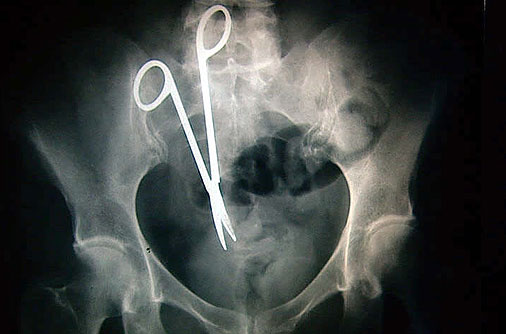 X-ray of scissors left inside Pat Skinner's stomach of Hurstvlle during a  operation at St George Hospital, Sydney