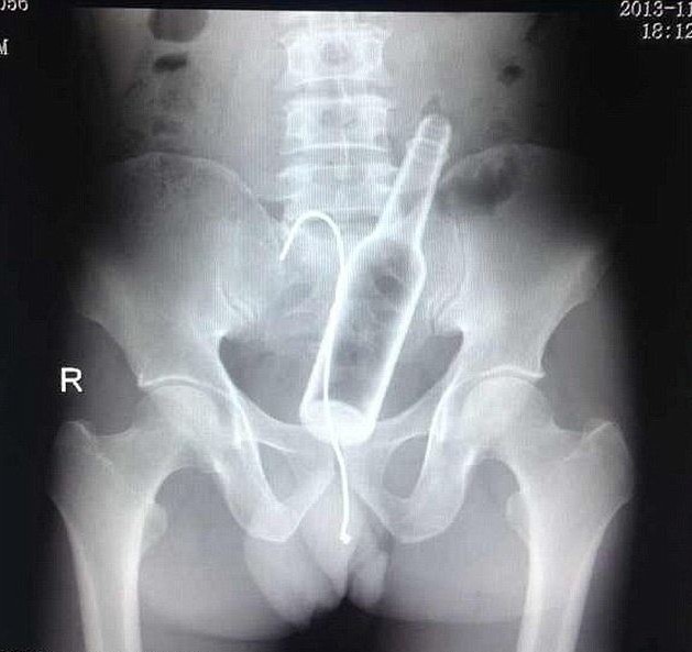 A Chinese man was complaining of stomach pains.The man, was forced to seek medical help after failing to extract a bottle with a curved piece of wire. When medical staff quizzed him on the pain, he claimed he did not know what was causing his discomfort.But he suddenly remembered what had happened when staff presented him with clear X-rays showing the bottle and wire inside of him. He admitted inserting the bottle at home before it became stuck and said he used a steel wire in an attempt to get it back out in a moment of panic.
