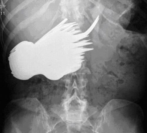 52-year-old Dutchwoman Margaret Daalman came to hospital complaining of stomach ache, and one glance at her X-ray shows why.Surgeons in Rotterdam in the Netherlands were astonished when X-rays showed 78 different items of cutlery in her stomach.