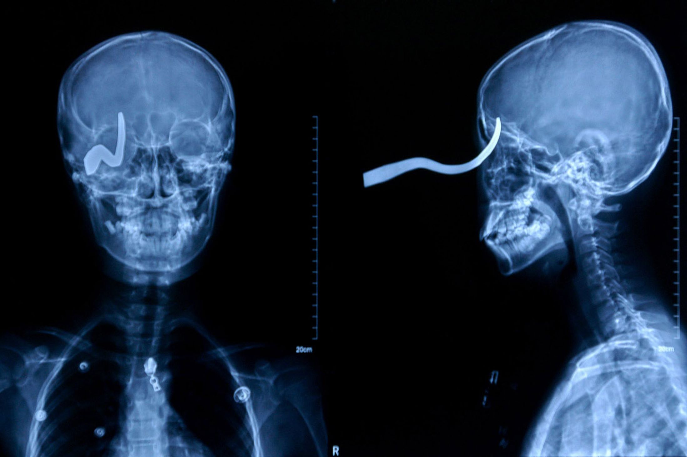 A 13-year-old slipped on an icy school floor in China. Xiao Lin fell forward onto a hook which embedded in his eye. A school handyman sawed the hook off the wall to free the lad, leaving 5cm sticking out of his head. Surgeon Yan Shijun commented: "The hook pierced his skull but was turned to the side by the impact. Any movement would have sent it into his brain and he could have died on the spot." He added: "He has lost his right eye but he's very lucky to be alive at all."