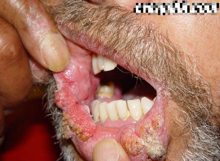 chewing tobacco is sick !
