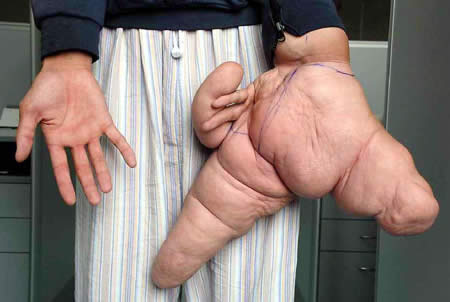 Lui Hua World's Largest Hand --his left thumb is 10.2 inches long