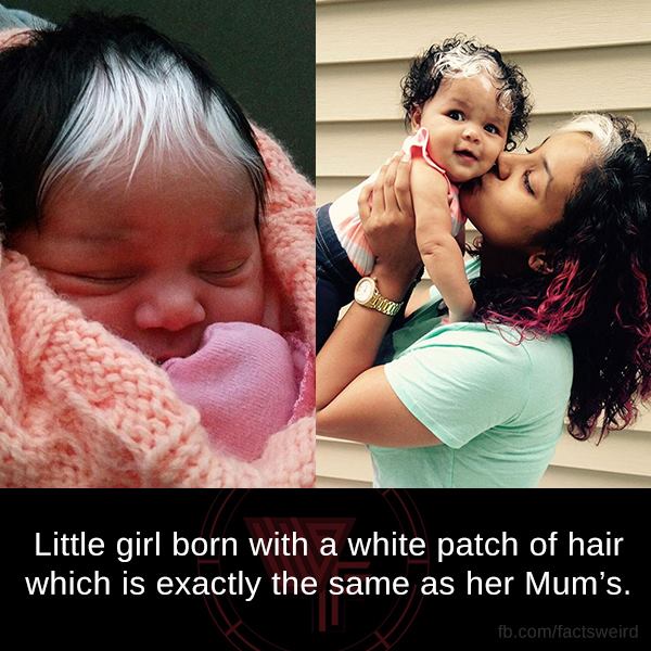 little girl born with a white patch - Little girl born with a white patch of hair which is exactly the same as her Mum's. fb.comfactsweird