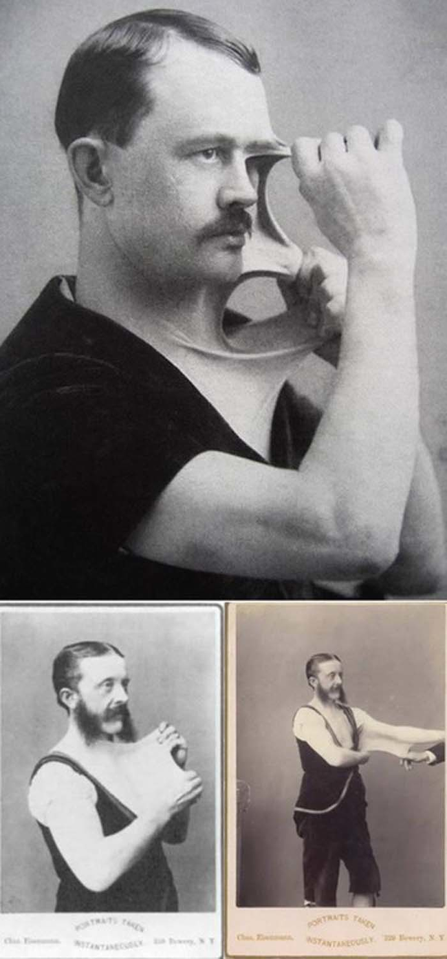 Felix Wehlre, also known as "The Elastic Man" had a condition called Ehlers-Danlos Syndrome that caused a collagen deficiency that allowed him to stretch his skin. 