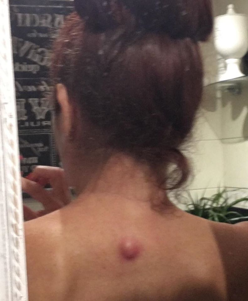 "This started life as a pea size lump under my skin. and remained unchanged for over 2 years. A couple of weeks ago it started to grow and in the 4 days I had to wait before seeing my GP it had over trebled on size."