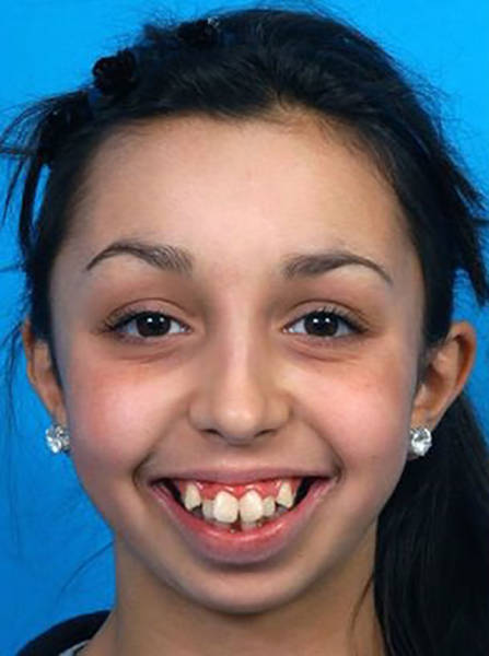 When Ellie Jones came to her orthodontist to have braces at 14 she discovered that her jaw had stopped growing when she was eight. That was quite a shock for her. But thanks to her orthodontist Joy Hickman and surgeon Emma Woolley her face was completely transformed.