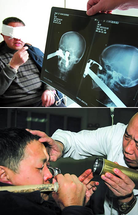 These amazing X-rays show how a man arrived with a tap and 16 inches of pipework stuck in his eye at a hospital's casualty unit. But the terrified patient was forced to pull the tap out himself - because surgeons took three hours to send for a plumber to get it out. Yi Zhao, 57, had slipped in the bath impaling his left eye on the tap at his home.