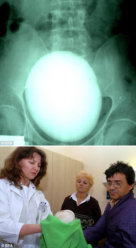 This 2.5lb and 17 cm in diameter kidney stone was removed from a patient in Hungary.
