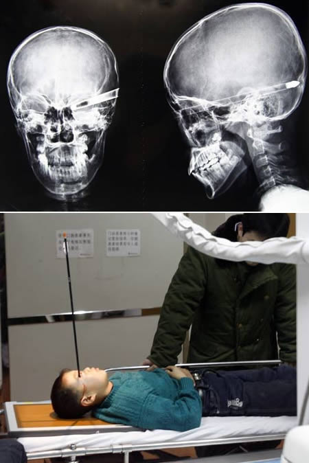 Eleven-year-old Chinese schoolboy Liu Cheong had a brush with death when his friend shot him in the head with a 16-inch arrow, according to numerous international media reports. The arrow entered his skull through the eye socket and lodged in the back of his head. Somehow, the boy was spared a fatal brain injury.