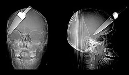 X-ray images show how a teenage boy cheated death when a 5-inch knife was plunged into his head. The 16-year-old and two other young men were injured when they tried to stop a friend getting robbed at a bus stop. The teenager was rushed to hospital with the kitchen knife still stuck in his forehead after the attack in Walworth, south London, in September 2008.