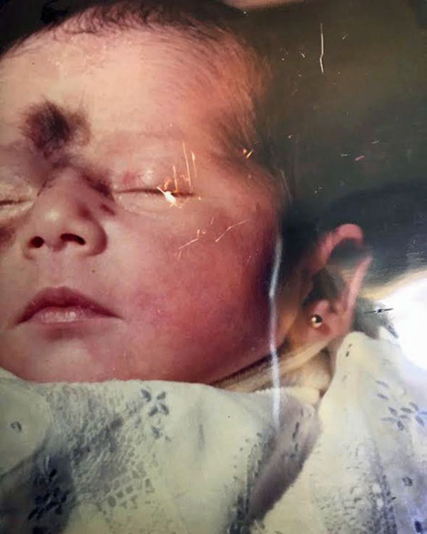 Mariana from Juiz de Fora, Brazil was born with congenital melanocytic nevus  (s a type of melanocytic nevus (or mole) found in infants at birth. ) This type of birthmark occurs in an estimated 1% of infants worldwide; it is located in the area of the head and neck 15% of the time.