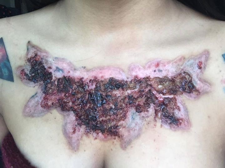 Woman Enjoys Her Tattoo Until It Falls Off And Takes Her Skin With It