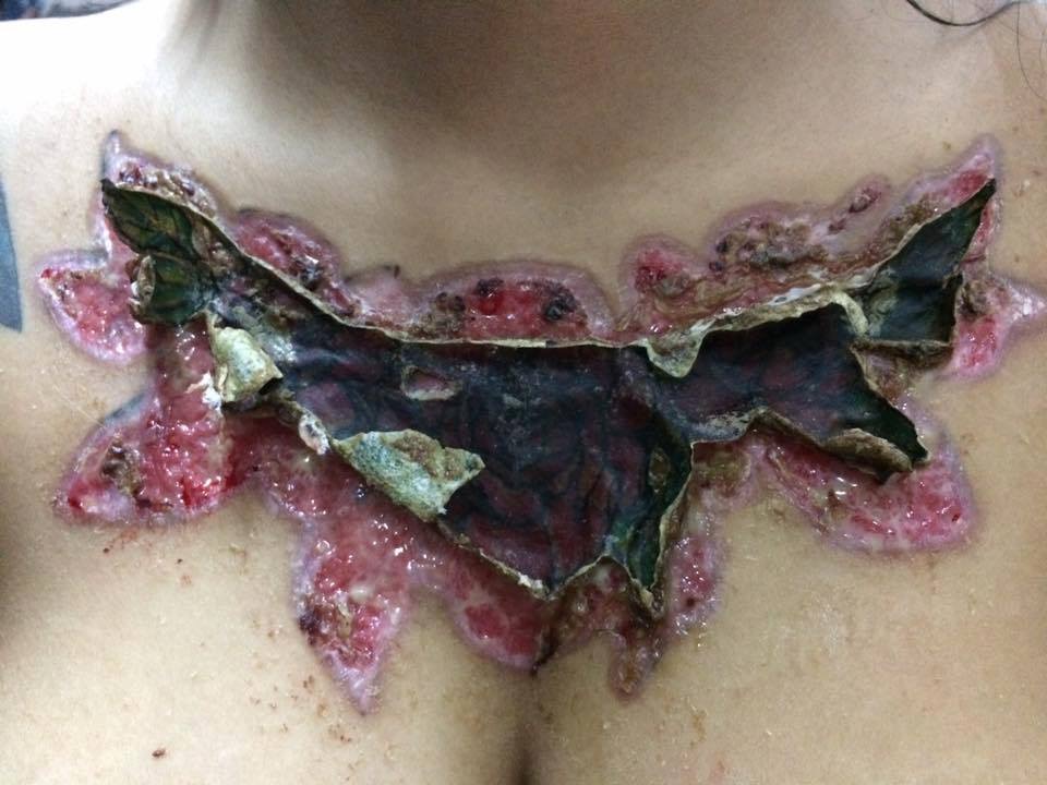 Woman Enjoys Her Tattoo Until It Falls Off And Takes Her Skin With It