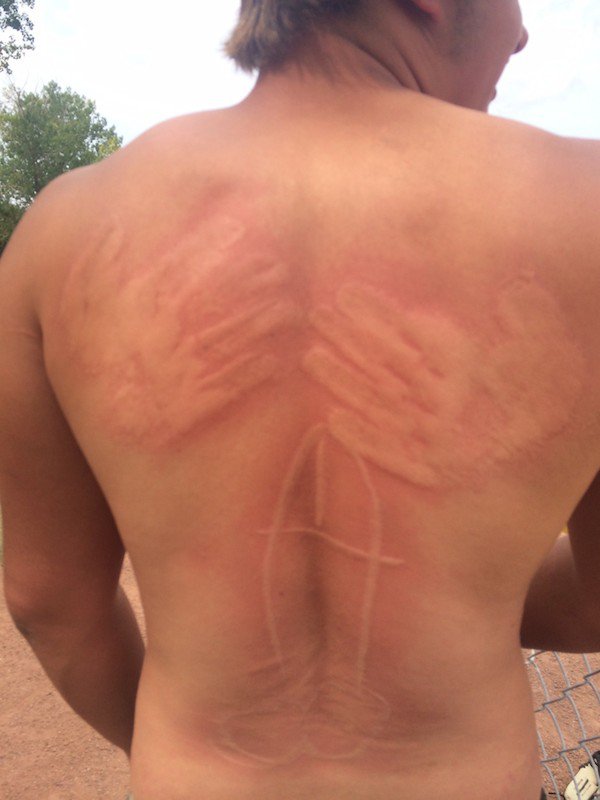 Funny pattern on man's back most likely from pranksters that wrote it with sunblock as he tanned.