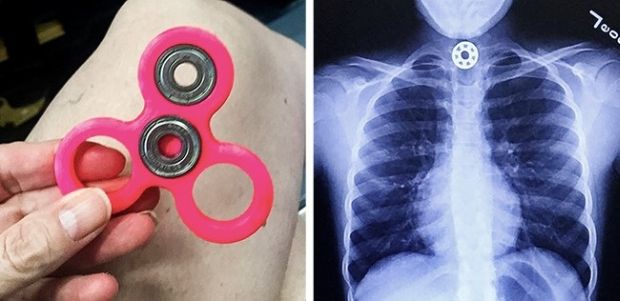 Fidget spinner. A part of the spinner may detach during spinning and cause injuries. There also are cases when children swallowed parts of it. Besides, such a toy prevents the child from concentrating, which leads to study issues.