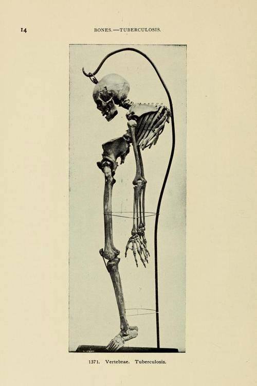 Vertebrae, 1910. Tuberculosis. From the Warren Anatomical Museum.