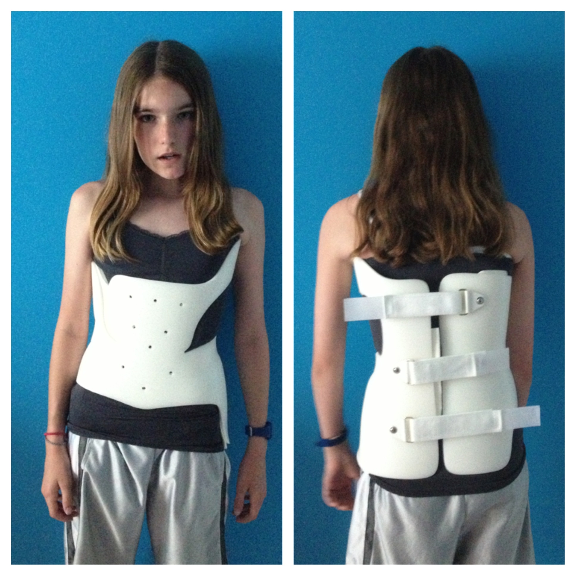With a bad case of scoliosis she wore a brace like this for 3 years straight, 23 hours a day, from age 12 to 15. (Not actually her in the photo but the same type of brace she had)
