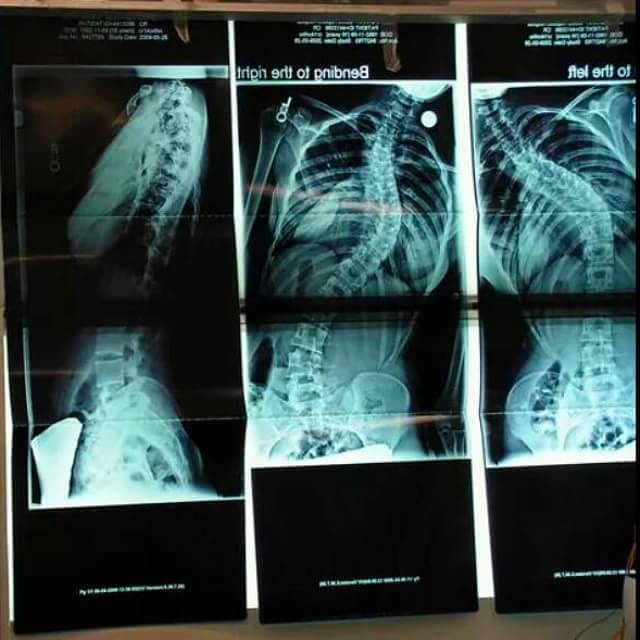 "Age 16. X-rays of my curvature taken on the day of my surgery in the OR. Top curve was 62°, bottom curve ~48°."