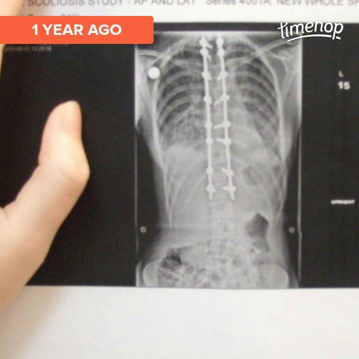 "Post-op, 2 rods and 16 bolts. Added 2" to my height. Note the change in my ribs. Also affected the placement of my organs, as my lungs now have room to expand and I can finally take deep breaths."