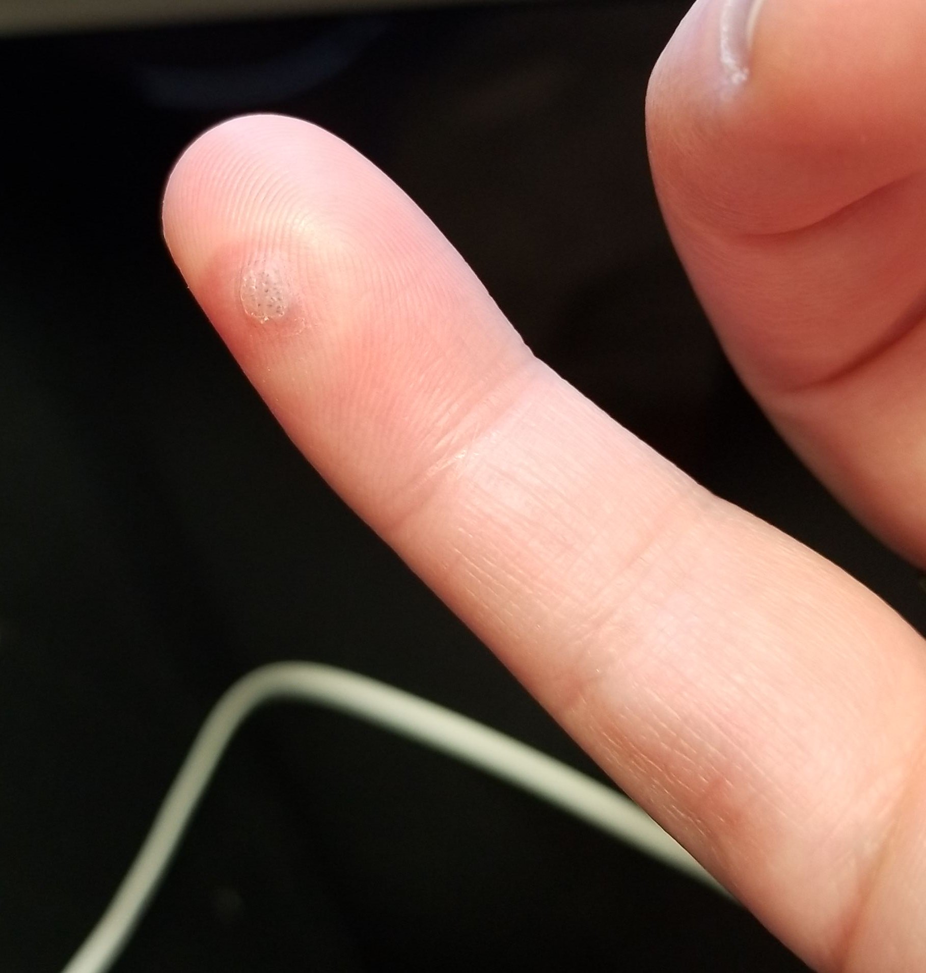 Guy tries to get rid of a wart, this is what he wrote- "This is right after getting my wart sprayed with liquid nitrogen at my Dr. It hurt a lot! The pain was going from my finger tip to my elbow to my shoulder. I wanted to get rid of it because ew, it was on my finger."